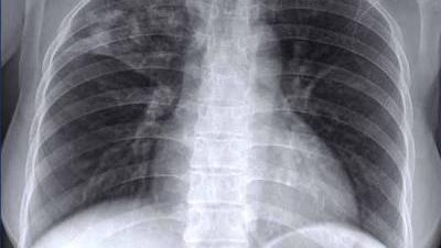 Кожен четвертий хворий у Криму має стійку форму туберкульозу: епідемічна ситуація на півострові залишається напруженою